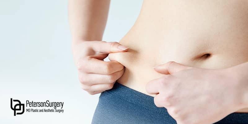 Peterson MD - Blog - Common Myths About Tummy Tucks